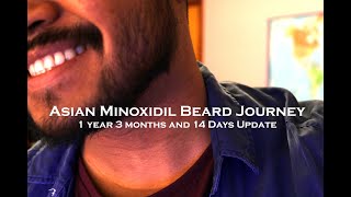 AsianFilipino Minoxidil Beard Journey 1 Year 3 Months and 14 days Update [upl. by Skutchan]