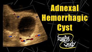 Adnexal Hemorrhagic Cyst  Ultrasound  Case 63 [upl. by Tletski]