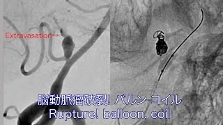 脳動脈瘤コイル塞栓 術中破裂2 Cerebral aneurysm intraprocedural rupture 2 [upl. by Ainosal]