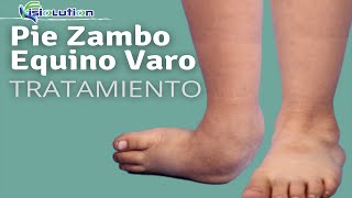 CONSEJOS para PIE ZAMBO  ¿Qué es TRATAMIENTO y EJERCICIOS  Fisiolution [upl. by Vareck570]