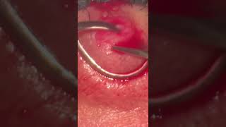 Chalazion surgery Chalazion Expert Advice for Quick Healing [upl. by Anniken]