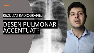 Ce înseamnă desen pulmonar accentuat pe radiografie [upl. by Gitt]