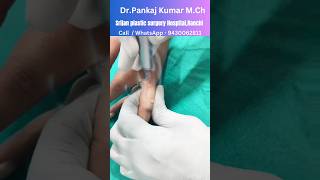 Laser wart removal wart removal in Ranchi laser treatment of warts shorts youtubeshorts [upl. by Parfitt]