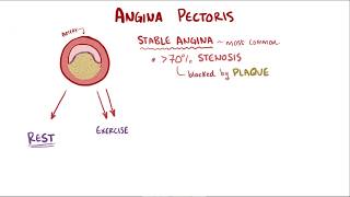 Angina pectoris  stable unstable prinzmetal vasospastic and symptoms [upl. by Tan]