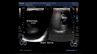 Hydrocele testicular mass and large Epididymal Cyst [upl. by Ahsele956]