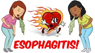 Esophagitis [upl. by Ahsillek]