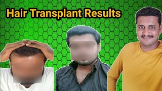 Hair Transplant in Kannada  HSN Bangalore  Hair Transplant result in kannada [upl. by Maghutte]