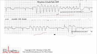 ECG Interpretation Tutorial  ChalkTalk 09  Advanced Level [upl. by Chip]