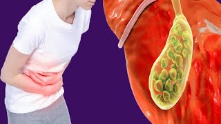 Gallbladder Pain Treatment And When To See A Doctor [upl. by Ysset]