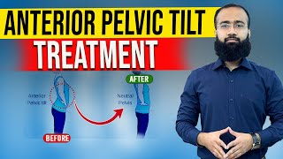 Get Rid Of Anterior Pelvic Tilt Fast With Easy Home Remedies [upl. by Nial579]