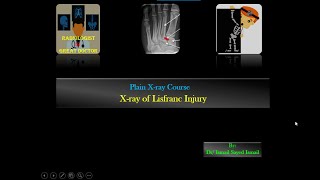 X ray of Lisfranc injury For Radiology Residents [upl. by Eenar]