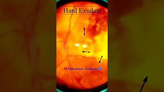 Diabetic retinopathy  Hemorrhages  Hard exudates  Fundus  Short Video 188 [upl. by Doubler]