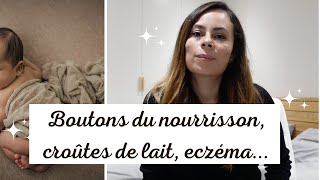 Croûtes de lait acné du nourrisson érythème toxique eczéma milium et traitements naturels [upl. by Adnawt]