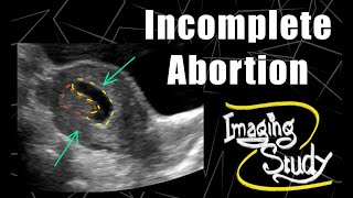 Incomplete Abortion  RPOC  Ultrasound  Case 166 [upl. by Nnaeiluj]