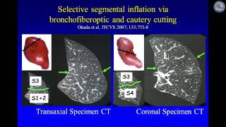 Keynote Lecture Open thoracoscopic and robotic segmentectomy for lung cancer [upl. by Otter]