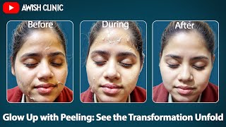 Peeling Procedure Step by Step  Skin peeling Day by Day  Peeling Results by Dr Vijay Kumar [upl. by Elayor]