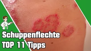 Schuppenflechte entfernen und heilen  TOP 11 Tipps 💯 [upl. by Tareyn]