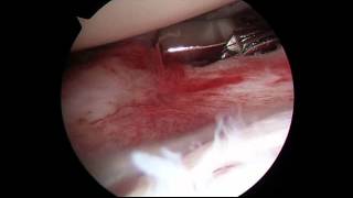 Frozen shoulder arthroscopic release [upl. by Ranite]