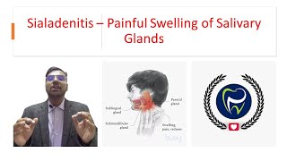 Dr Rudra Mohan  Sialadenitis  Painful Inflammatory Swelling of Salivary Glands [upl. by Vershen]