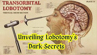 The Dark Legacy of Lobotomy Historys Most Horrifying Medical Procedure [upl. by Andromeda]