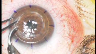 Trapianto cheratoplastica lamellare con microcheratomo  Corneal transplantation with microkeratome [upl. by Seana]