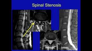 UCSF Radiology Spinal Stenosis [upl. by Woodson]