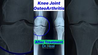 Knee joint Osteoarthritis Recovery After Treatment yt ytshort trending trendingshorts fyp ad [upl. by Quenna585]