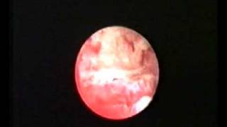 hysteroscopic treatment of osteoid metaplasia [upl. by Leighland]