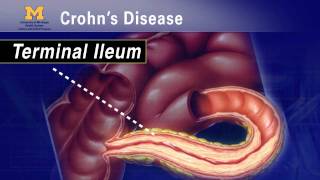 IBD School 102  What is Crohns Disease [upl. by Free854]