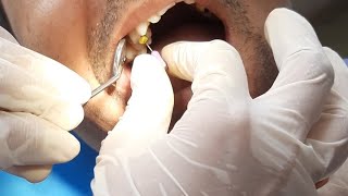 Root canal therapy RCT of upper right 1st premolar Root canal preparation all procedures [upl. by Neilson]