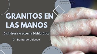 GRANITOS EN LAS MANOS PRURITO Vejiguitas en los dedos DISHIDROSIS O ECCEMA DISHIDRÓTICO 🖐 [upl. by Muhan]