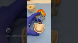 Amelogenesis imperfecta dentist viralreels teeth bestdentist viralvideo viral implant [upl. by Ynnub]