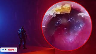 The Truth About earwax Will Shock You How to remove earwax from ear earwax extractions [upl. by Calisa]