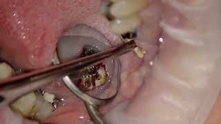 Minimally invasive method for extraction of upper molars Piezotome ActeonCube TipsExtraction Kit [upl. by Gnas]