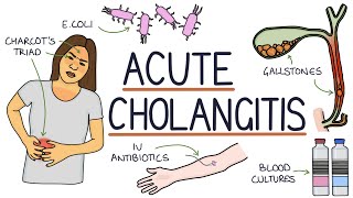 Understanding Acute Cholangitis Ascending Cholangitis [upl. by Haugen775]