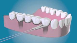 TePe Bridge amp Implant Floss  für die Reinigung um die Implantate [upl. by Arbe235]