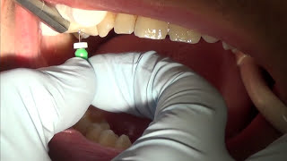 root canal treatment part 1 [upl. by Eelahc]