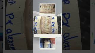 Zirconia denture by Salvador client shorts [upl. by Delija718]