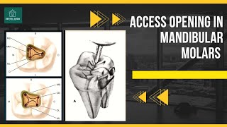 How to Perform access opening in Mandibular Molars [upl. by Magnuson489]