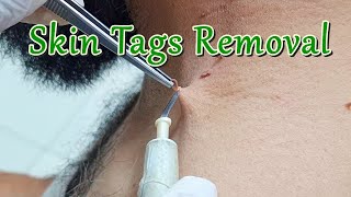 How to Remove Skin Tags around Neck with Electric Cautery  Skin Tag Removal Procedure [upl. by Just]