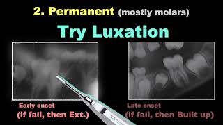 Treatment of Ankylosis  Part 1｜【Chris Chang Ortho】CC762 [upl. by Souvaine]