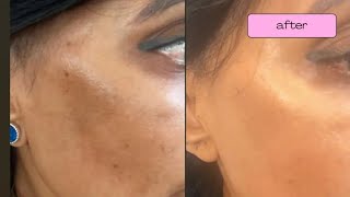 Before and After results Available from wwwskincarebydrvcom [upl. by Valenba]