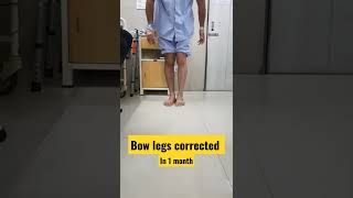 bow legs corrected [upl. by Ilak]