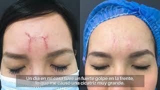 Testimonio de cicatriz hipertrófica  Clínica Dermatológica Ollague [upl. by Icyac895]