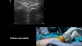 Ultrasound guided upper limb botulinum toxin injections in cerebral palsy Murat Karkucak MD [upl. by Mendes]