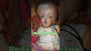 Hydrocephalus  Water on the Brain  बड़ा सिर वाला [upl. by Sherar]