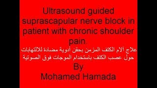 Ultrasound Guided suprascapular Nerve Block [upl. by Eckel]