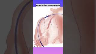 Recanalización de trompas de Falopio [upl. by Zrike544]