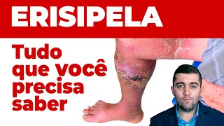 Erispela como curar sinais e sintomas e como prevenir suas complicações Guia completo da doença [upl. by Toulon]