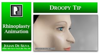 Rhinoplasty Animation How can a Droopy Nasal Tip be lifted [upl. by Trev45]